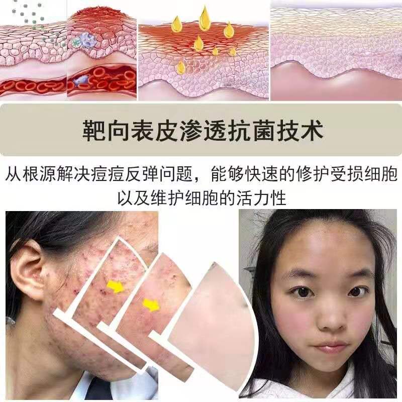 脸颊长闭口痘痘的原因分析