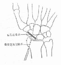 右手舟骨骨折能评几级伤残