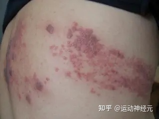 结节是怎么回事
