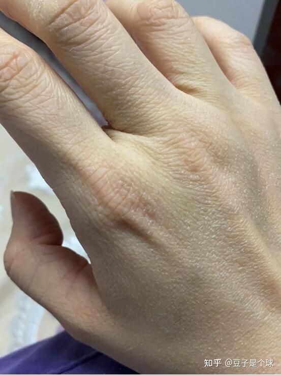 手指上起皮是怎么回事