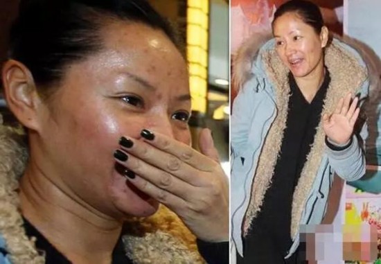 瞿颖痘痘如何治好的