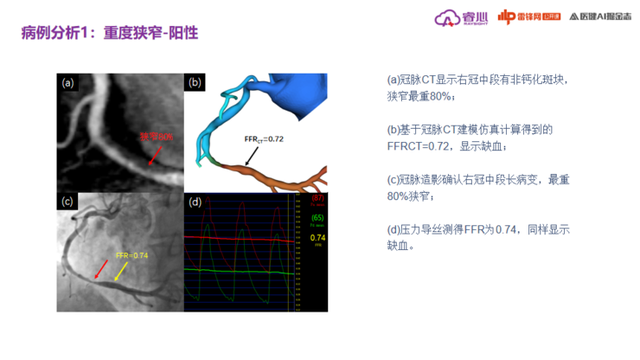 冠状动脉钙化怎么治疗