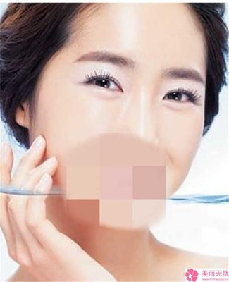 玻尿酸除皱需要多少钱