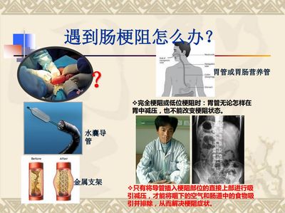 胃梗阻怎么治疗