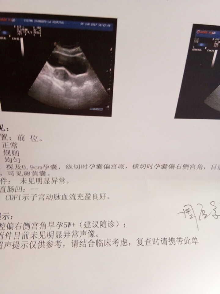 怀孕3个月孕囊多大