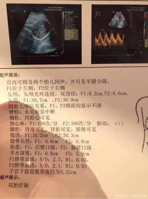 胎儿多少斤正常