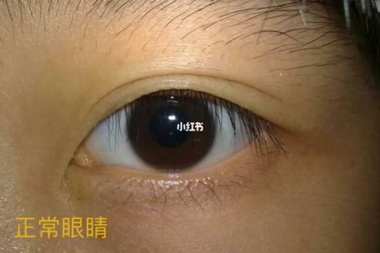 眼睛一般是多少度正常吗