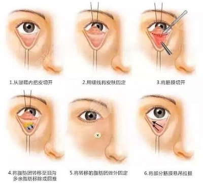 外切眼袋皱纹多久消除