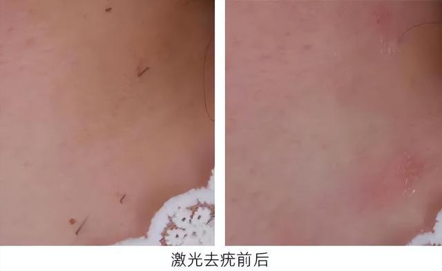 背部 激光治疗 痘痘