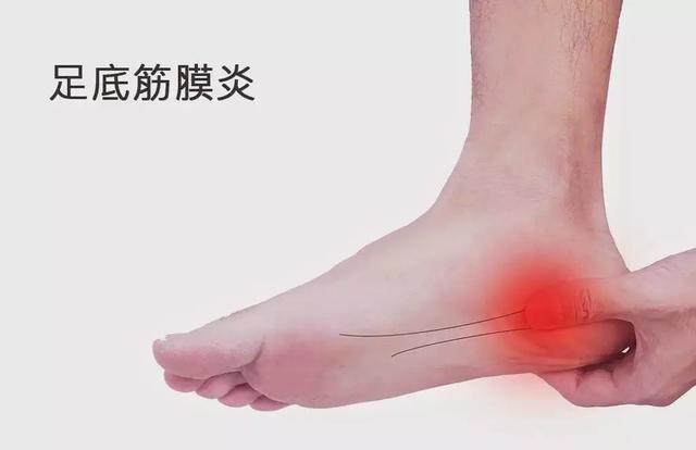 筋膜炎怎么治疗好得快