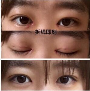 双眼皮切口处发红
