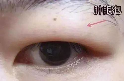 单眼皮肿眼泡怎么贴双眼皮