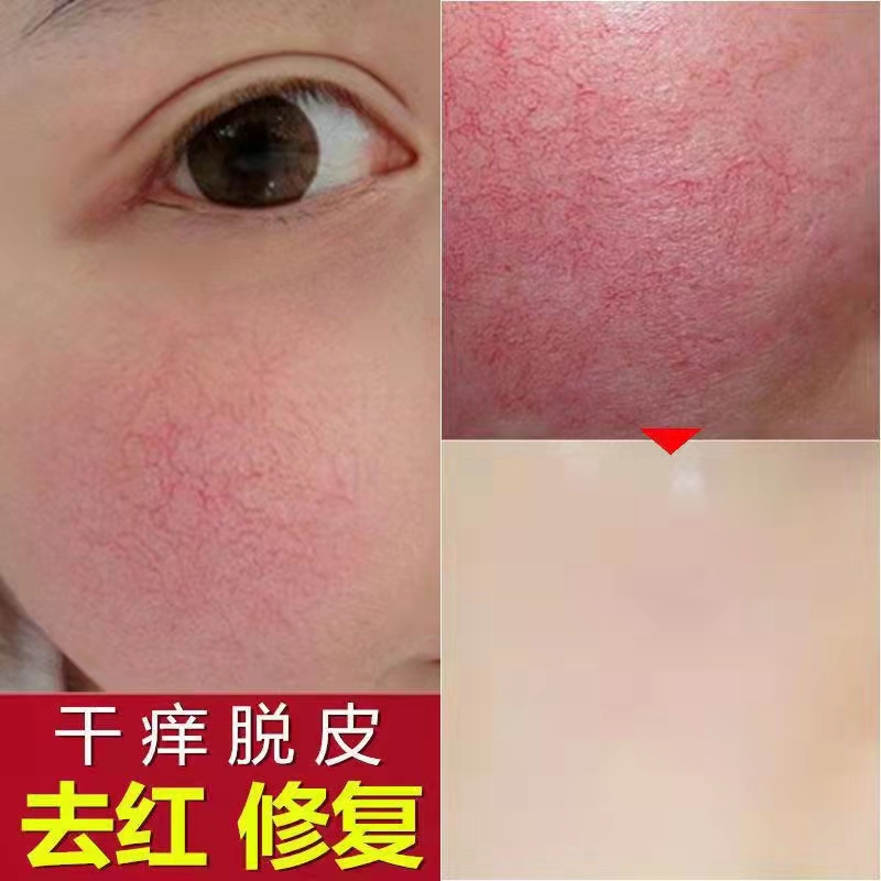 脸部角质层增厚