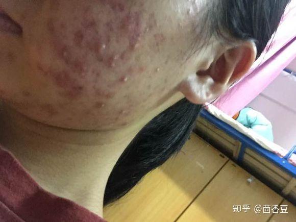 脸过敏痘痘