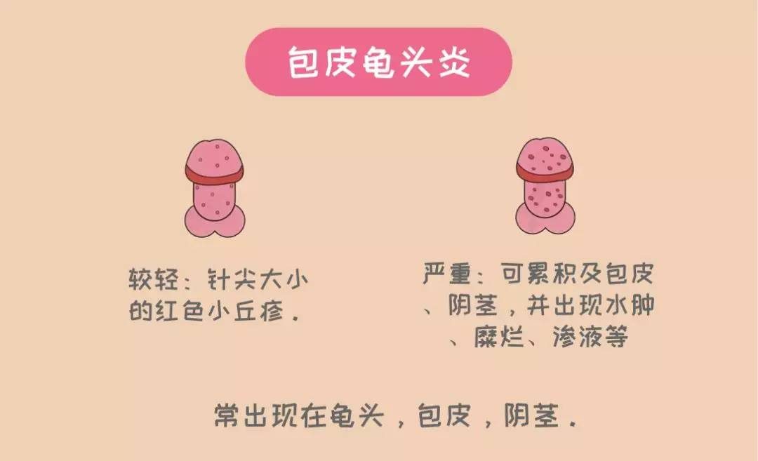 包皮浮肿是怎么回事