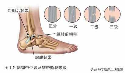 脚外侧疼是怎么回事