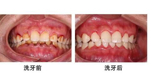 洗牙前要刷牙吗