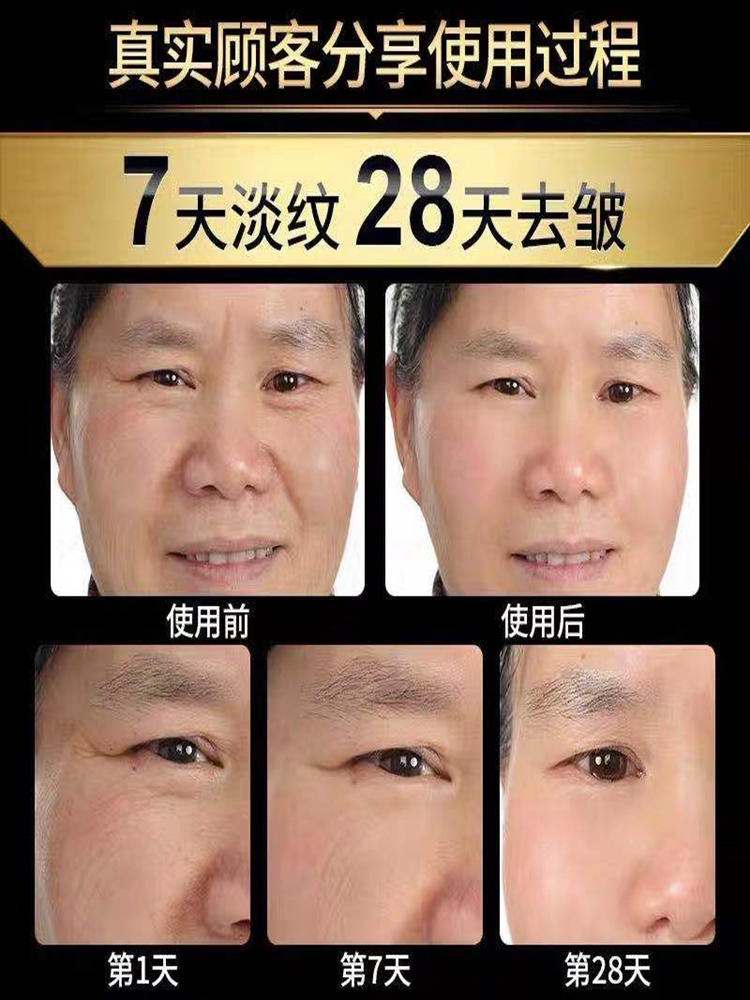 胶原蛋白填充法令纹