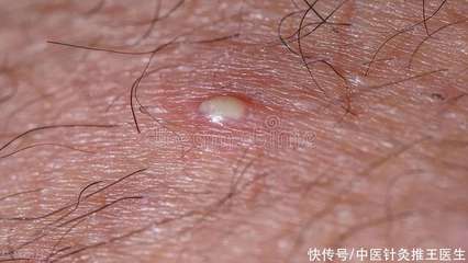 红肿的脓胞痘痘怎么治疗