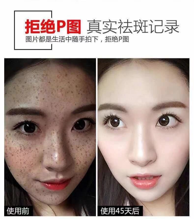 广州美白祛斑