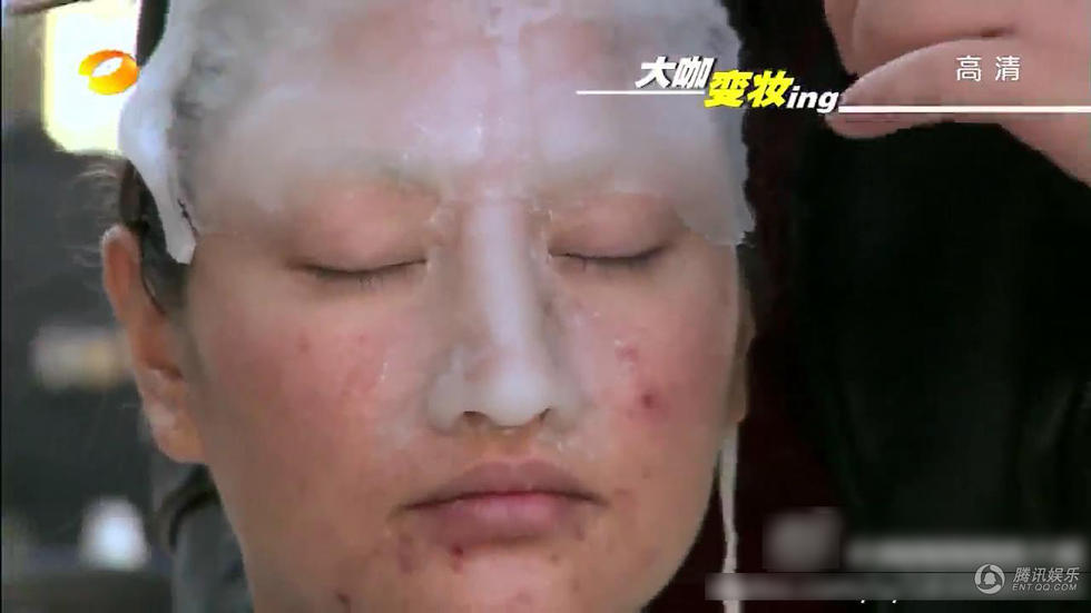 瞿颖痘痘如何治好的