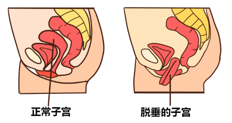 宫颈下垂怎么治疗