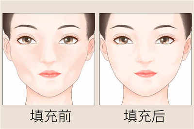 玻尿酸能去皱纹吗