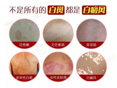 汗斑怎么治疗断根