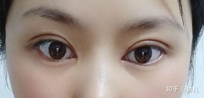 全切双眼皮恢复过程