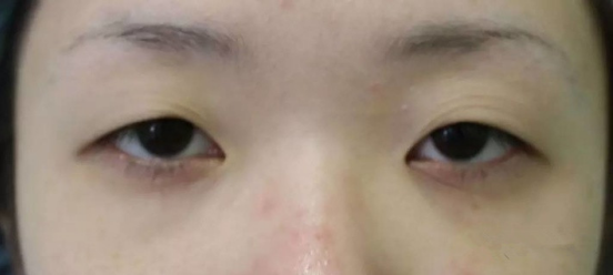 眼皮耷拉是什么病
