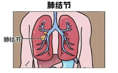 肺结节中医怎么治疗