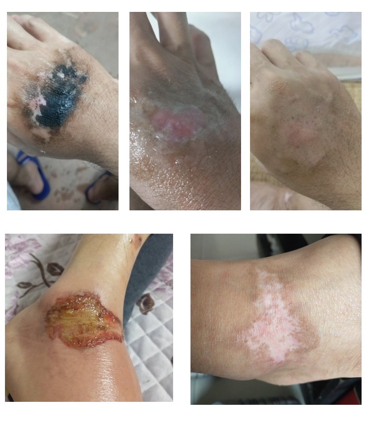 烫烧膏擦痘痘管用吗
