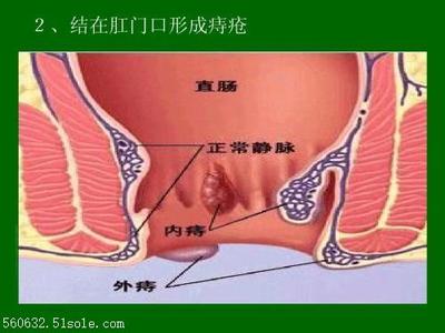 内痔外痔怎么治疗