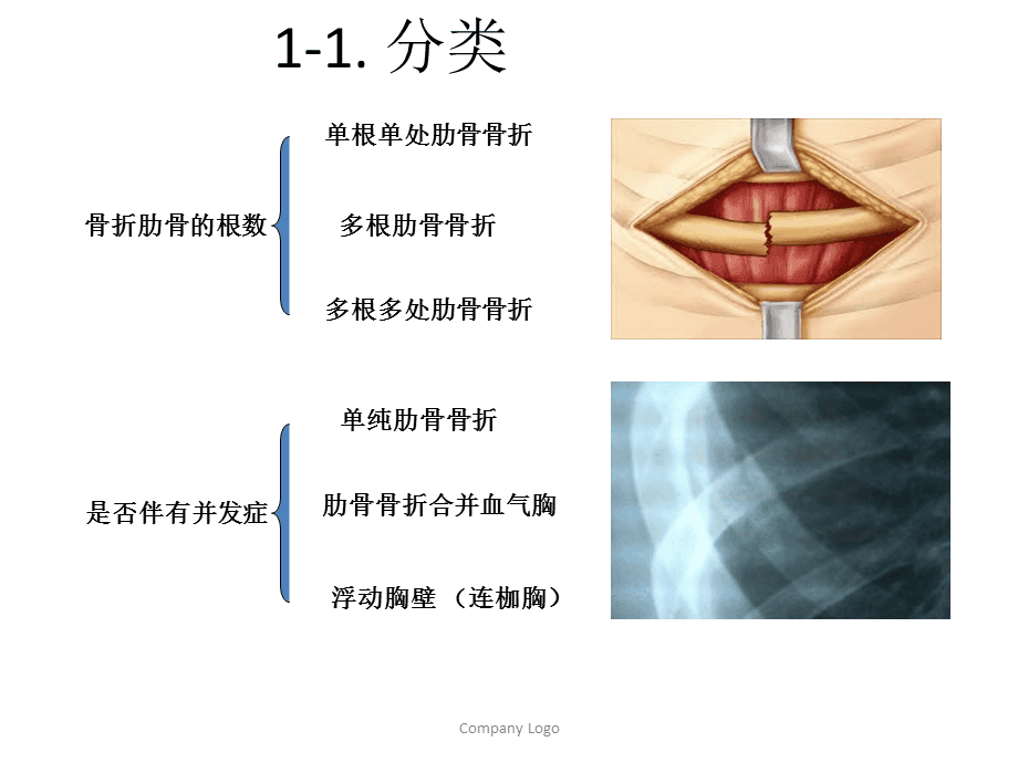 肋骨骨折需要怎么治疗