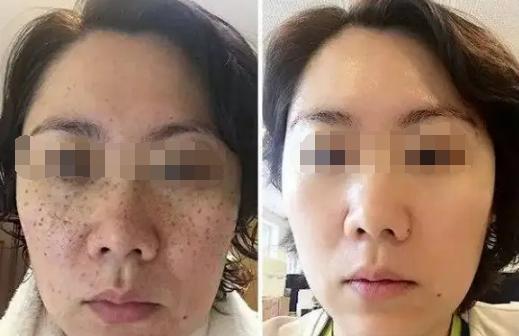 十大美白祛斑排行榜
