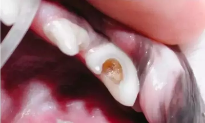 做梦牙烂了怎么回事