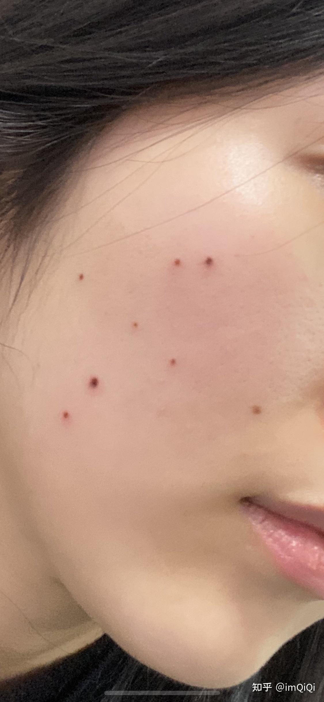 点痣以后怎么快速恢复