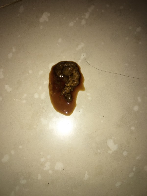 拉黑色粑粑是怎么回事