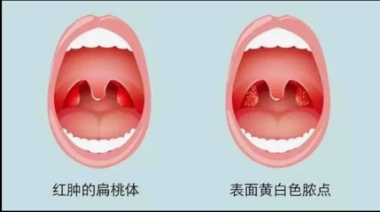 扁桃体一个月发炎三次