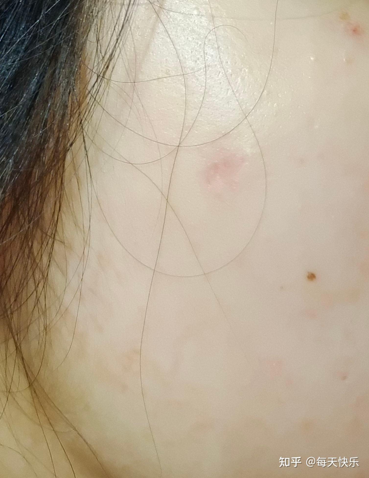 祛痣后的红印怎样消除