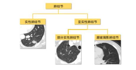 0.6厘米玻璃结节手术割多少好