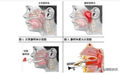 腺样体肥大怎么治疗最好