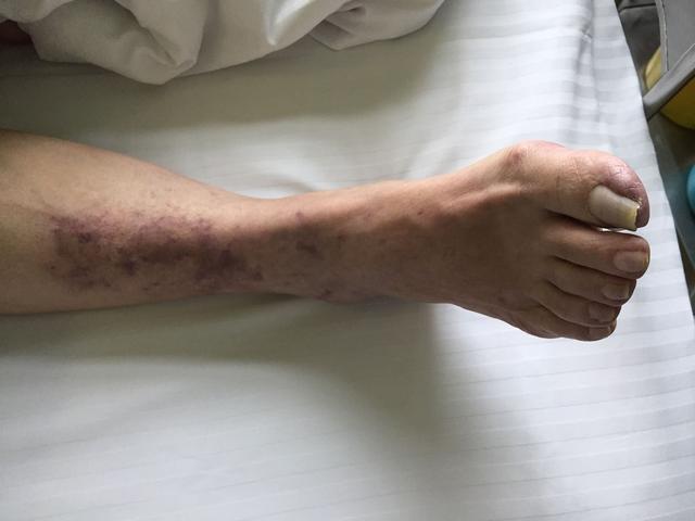 大血管堵塞怎么治疗