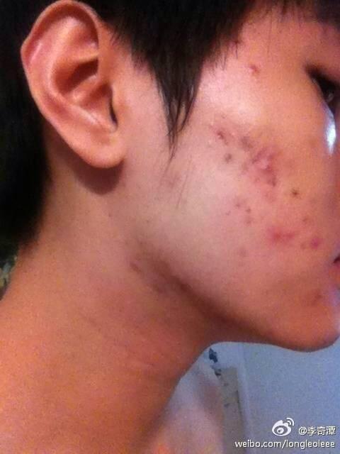 痘痘男護膚哪個好