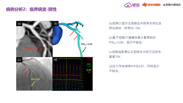 冠状动脉钙化怎么治疗