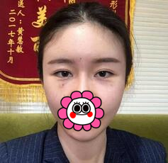 玻尿酸打泪沟几天消肿