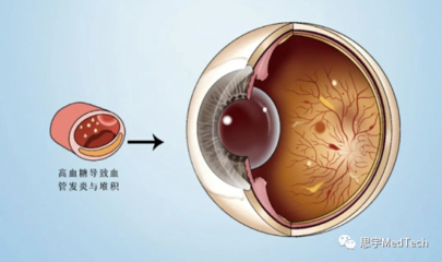 眼底发炎怎么治疗