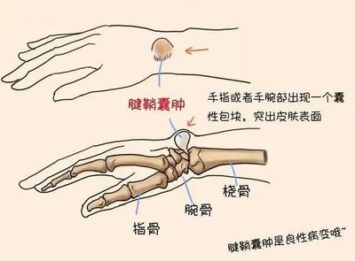 手指关节腱鞘囊肿怎么治疗
