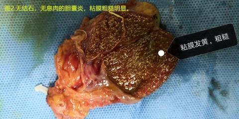 胆囊表面粗糙是怎么回事