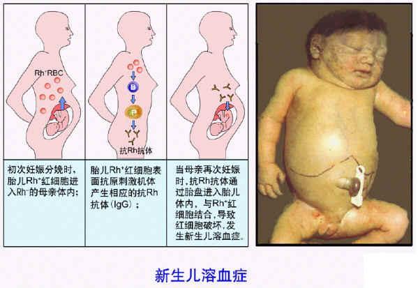 o型血的孕妇